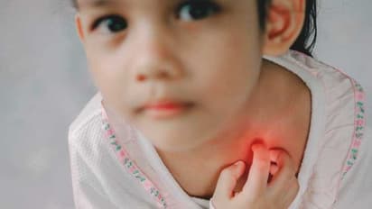 ശരീരം ചൊറിഞ്ഞ് തടിക്കുന്ന ഹീറ്റ് റാഷ്, ബാധിക്കുന്നത് കൂടുതലും കുട്ടികളെ; അതീവ ശ്രദ്ധ വേണമെന്ന് മുന്നറിയിപ്പ്