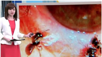 അണുബാധയ്ക്ക് ചികിത്സ തേടി; യുവതിയുടെ കണ്ണില്നിന്ന് പുറത്തെടുത്തത് നാല് തേനീച്ചകള്!