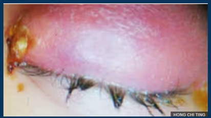 യുവതിയുടെ കണ്ണില് ജീവിച്ചിരുന്ന നാല് തേനീച്ചകളെ ഡോക്ടര്മാര് നീക്കം ചെയ്തു