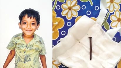 బాలుడి గొంతులో మేకు.. ఆపరేషన్ చేసి బయటకు తీశారు