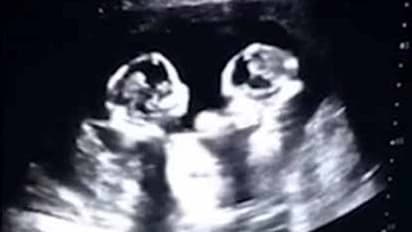 தாயின் வயிற்றில் சண்டையிடும் செர்ரி மற்றும் ஸ்ட்ராபெர்ரி..!காணக்கிடைக்காத  வீடியோ..!