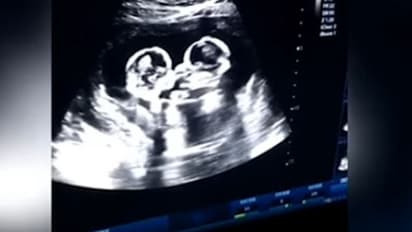 பிறப்பதற்க்கு முன்பே தாயின் வயிற்றில் சண்டையிட்ட இரட்டை குழந்தைகள்! வைரலாகும் காட்சி!