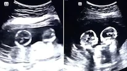 ತಾಯಿ ಹೊಟ್ಟೆಯೊಳಗೇ ಹೊಡೆದಾಡಿಕೊಂಡ ಅವಳಿ ಮಕ್ಕಳು: ವಿಡಿಯೋ ವೈರಲ್