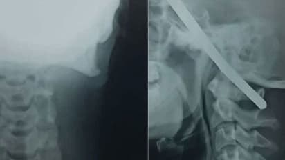 തലയിലൂടെ കമ്പി കയറിയിറങ്ങി; ബോധം നഷ്ടപ്പെടാതെ ആശുപത്രി വരെയെത്തി