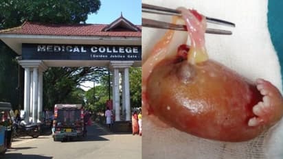 45 ദിവസം പ്രായമുള്ള ആണ്കുഞ്ഞിന്റെ വയറ്റില് ഭ്രൂണാവസ്ഥയിലുള്ള ശിശു