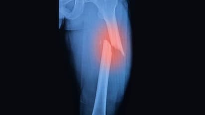 ಮೂಳೆಗೆ ಏಟು ಸಣ್ಣದಾದರೂ ಭವಿಷ್ಯದಲ್ಲಿ ಬೇನೆ ಕಟ್ಟಿಟ್ಟ ಬುತ್ತಿ