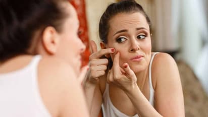 മുഖക്കുരു മാറ്റാൻ വീട്ടിൽ പരീക്ഷിക്കാവുന്ന 3 തരം ഫേസ് പാക്കുകൾ ഇതാ...