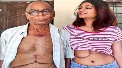 ತಂದೆ ಉಳಿಸಲು ತನ್ನ ಶೇ.65ರಷ್ಟು ಲಿವರ್ ದಾನ ಮಾಡಿದ ಪುತ್ರಿ!