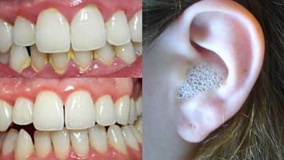 പല്ലിലെ മഞ്ഞനിറം അകറ്റാനും ചെവിക്കായം വൃത്തിയാക്കാനും ഒരു എളുപ്പവഴി