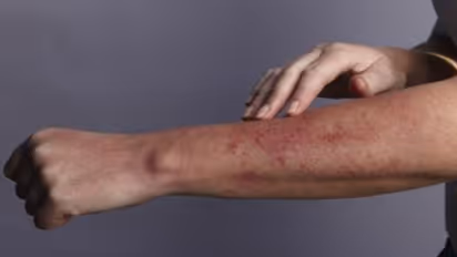 ലൂപ്പസ് രോഗത്തിന്‍റെ ശ്രദ്ധിക്കാതെ പോകുന്ന ലക്ഷണങ്ങള്‍