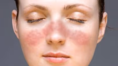 World Lupus Day 2024 : എന്താണ് ലൂപ്പസ് രോ​ഗം? ലക്ഷണങ്ങൾ എന്തൊക്കെ? 