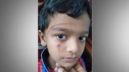 വീട്ടുമുറ്റത്ത് കളിച്ചുകൊണ്ടിരുന്ന ആറുവയസ്സുകാരന് സൂര്യതാപമേറ്റു