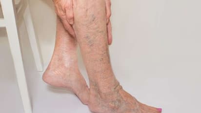 വെരിക്കോസ് വെയിൻ; ശ്രദ്ധിക്കേണ്ട ചില കാര്യങ്ങൾ