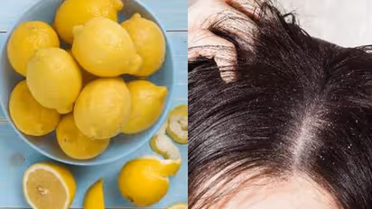 താരൻ അകറ്റാൻ നാരങ്ങ കൊണ്ടുള്ള 3 തരം ഹെയർ പാക്കുകൾ ഇതാ...