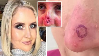 കണ്ടില്ലെന്നു നടിക്കരുത് മൂക്കത്ത് കാണുന്ന പാടുകൾ, ചിലപ്പോൾ അത്