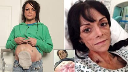 സിസേറിയന്‍ ചെയ്ത ഭാഗത്തിലൂടെ ആന്തരികാവയവങ്ങള്‍ മലത്തോടൊപ്പം പുറത്തേക്ക്,  പല അവയവങ്ങളും പ്രവര്‍ത്തനരഹിതം, അപൂർവരോ​ഗവുമായി 43കാരി