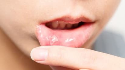 വായിലെ ക്യാൻസർ; ഈ ലക്ഷണങ്ങൾ കണ്ടാൽ നിസാരമാക്കരുത്