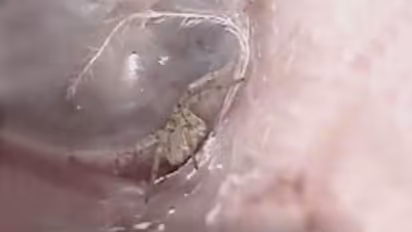 ചെവി ചൊറിയുന്നെന്ന് രോഗി; ഡോക്ടർക്ക് കിട്ടിയത് ജീവനുള്ള എട്ടുകാലിയെ