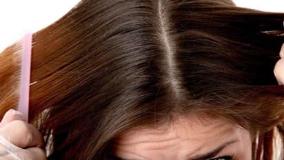 താരനകറ്റാന്‍ പുതിയ ചില വഴികള്‍...