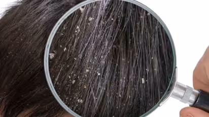 মাত্র ৭ দিনে মুক্তি পান খুসকির সমস্যা থেকে, রইল কার্যকরী ঘরোয়া সমাধান