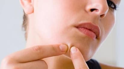 മുഖക്കുരു ഉണ്ടെങ്കിൽ ഈ 6 കാര്യങ്ങൾ ശ്രദ്ധിക്കണേ...