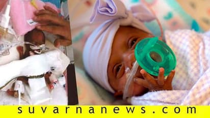 ಸೇಬು ಹಣ್ಣಿನಷ್ಟೇ ತೂಕವಿದ್ದ ವಿಶ್ವದ ಚಿಕ್ಕ ಮಗು ಆಸ್ಪತ್ರೆಯಿಂದ ಬಿಡುಗಡೆ!