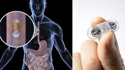 വരുന്നു, എൻഡോസ്കോപ്പിയ്ക്ക് പകരം, ഇത്തിരിക്കുഞ്ഞൻ റോബോട്ടിക് കാപ്സ്യൂളുകൾ