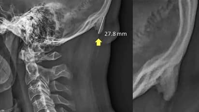 ಹೆಚ್ಚು ಮೊಬೈಲ್‌ ನೋಡಿದ್ರೆ ಕೋಡು ಬರುತ್ತೆ!: ಹೇಗೆ? ಯಾಕೆ? ಇಲ್ಲಿದೆ ಉತ್ತರ