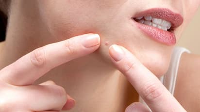 முகப்பருவால் கவலையா ..? உடனே இதை செய்யுங்கள்..!