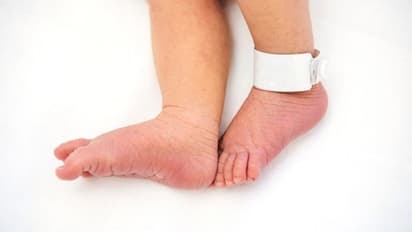 കൊവിഡ് 19 സ്ഥിരീകരിക്കുന്ന ലോകത്തെ ഏറ്റവും പ്രായം കുറഞ്ഞ രോഗി ലണ്ടനില്, പ്രായം മിനുട്ടുകള് മാത്രം