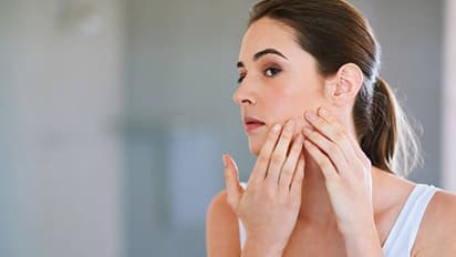 മുഖക്കുരു മാറാൻ ഇതാ അഞ്ച് മാർ​ഗങ്ങൾ