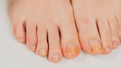 নখ দেখেই বুঝে নিন শরীরে কোন রোগ বাসা বাঁধতে চলেছে