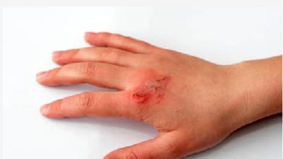 শরীরের কোনও অংশ পুড়ে গেলে চটজলদি কী করবেন, মাথায় রাখুন কয়েকটি টিপস