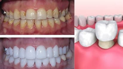 നിങ്ങളുടെ പല്ലിന് ക്യാപ്പിന്റെ ആവശ്യമുണ്ടോ?