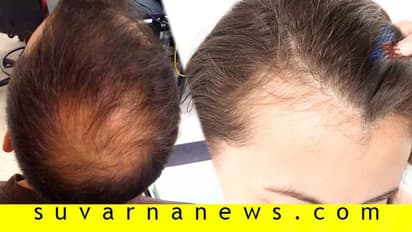 ನೀವು ಹೀಗೇ ಮಾಡುತ್ತಿದ್ದರೆ, ತಲೆ ಬೋಳಾಗುತ್ತೆ ಅಷ್ಟೇ...