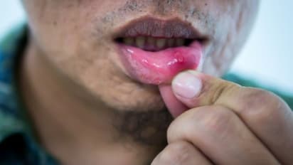 মুখের ভিতের আলসার! অসহ্য যন্ত্রণা থেকে বাঁচতে কী করবেন জানুন