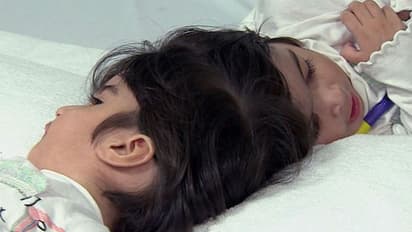 ജീവനും മരണത്തിനും ഇടയില് മണിക്കൂറുകള്; അപൂര്വ്വ ഇരട്ടകള് പിരിഞ്ഞു