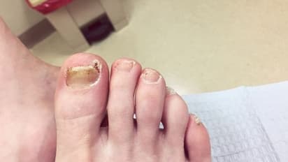 বৃষ্টি থেকে পায়ে দুর্গন্ধ ও চুলকুনি থেকে বাঁচতে রইল ৫ টোটকা