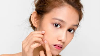 മധുരപലഹാരങ്ങള് മുഖക്കുരുവിനെ വരുത്തുമോ? ചെയ്യേണ്ട കാര്യങ്ങള്...