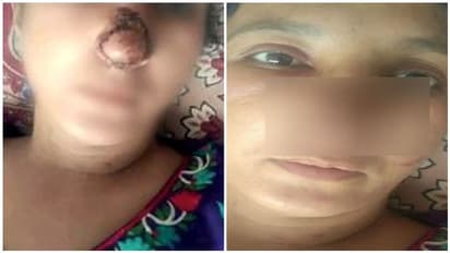 ரூ.3000 எடுத்தியா..? கேள்வி கேட்டதுக்கே மனைவியின் மூக்கை கடித்து துப்பிய கணவர்..! விசித்திர சம்பவம்..!