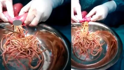 Fact Check| ನೂಡಲ್ಸ್ ಸೇವಿಸಿ, ಜೀರ್ಣವಾಗದೆ ಶಸ್ತ್ರಚಿಕಿತ್ಸೆ!