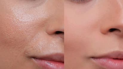 എണ്ണമയമുള്ള ചര്മ്മത്തിന് ഇക്കാര്യങ്ങള് പരീക്ഷിക്കാം...