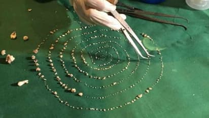 വീര്ത്ത കവിളുമായി ഏഴുവയസുകാരന്; ശസ്ത്രക്രിയയിലൂടെ നീക്കിയത് 526 പല്ലുകള്!