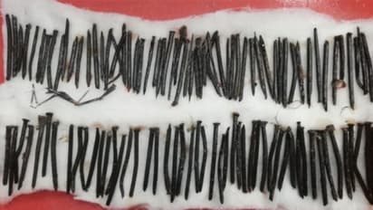 തൃശ്ശൂരില് ഒരു രോഗിയുടെ വയറ്റിൽ നിന്ന് പുറത്തെടുത്തത് 111 ആണികൾ !