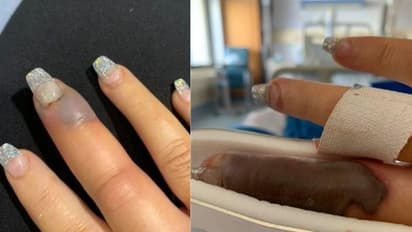 മാനിക്യൂര് ചെയ്ത യുവതിയുടെ വിരല് നീരുവെച്ച് ഗുരുതരാവസ്ഥയില്