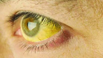 മഞ്ഞപ്പിത്തം; എടുക്കേണ്ട ചില മുൻകരുതലുകൾ