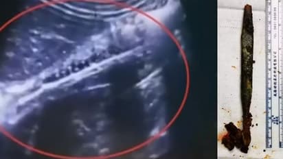 20 साल तक पेट में सड़ रहा था ब्रश, फिर...