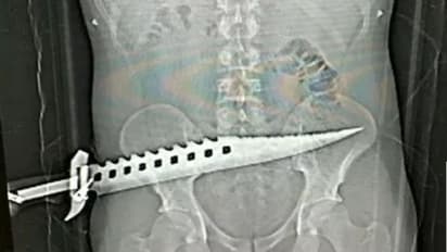 കഠാര മുഴുവനായും ശരീരത്തിലേക്ക് കുത്തിയിറക്കി; എക്സറേ കണ്ട് അമ്പരന്ന് ഡോക്ടര്മാര്