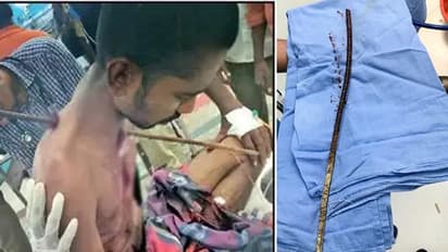 ఛాతీలోకి దూసుకెళ్లిన ఇనుప కడ్డీ: విజయవంతంగా తొలగించిన వైద్యులు