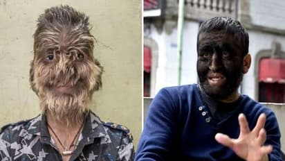 बच्चों में फैल रही है ये भयानक बीमारी